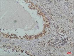 Immunohistochemical analysis of paraffin-embedded Human Lung Carcinoma using IκB β(Mouse mAb diluted at 1:200.