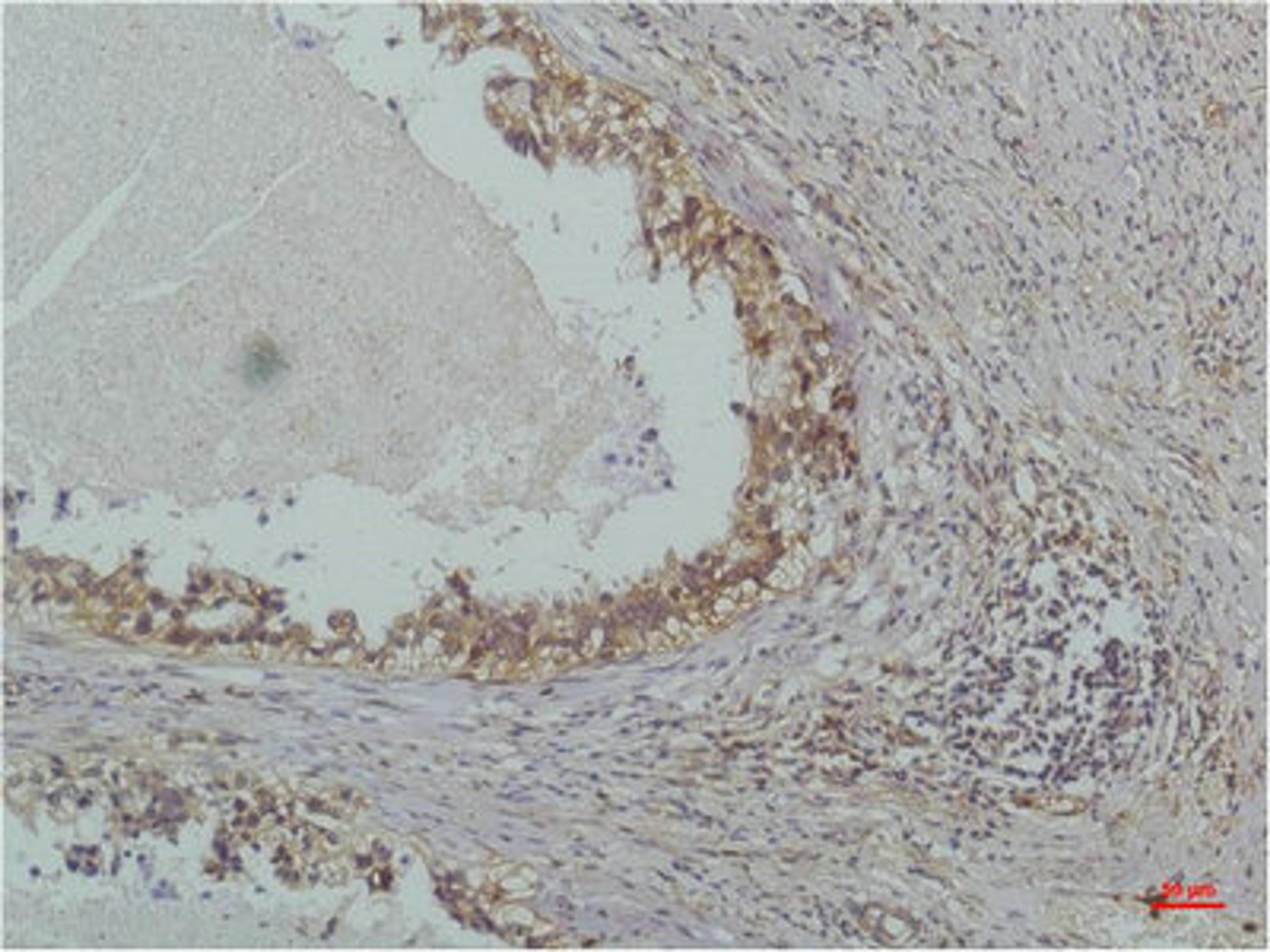 Immunohistochemical analysis of paraffin-embedded Human Lung Carcinoma using IκB β(Mouse mAb diluted at 1:200.