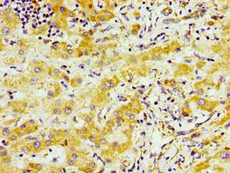 Immunohistochemistry of paraffin-embedded human liver cancer using CSB-PA745330LA01HU at dilution of 1:100