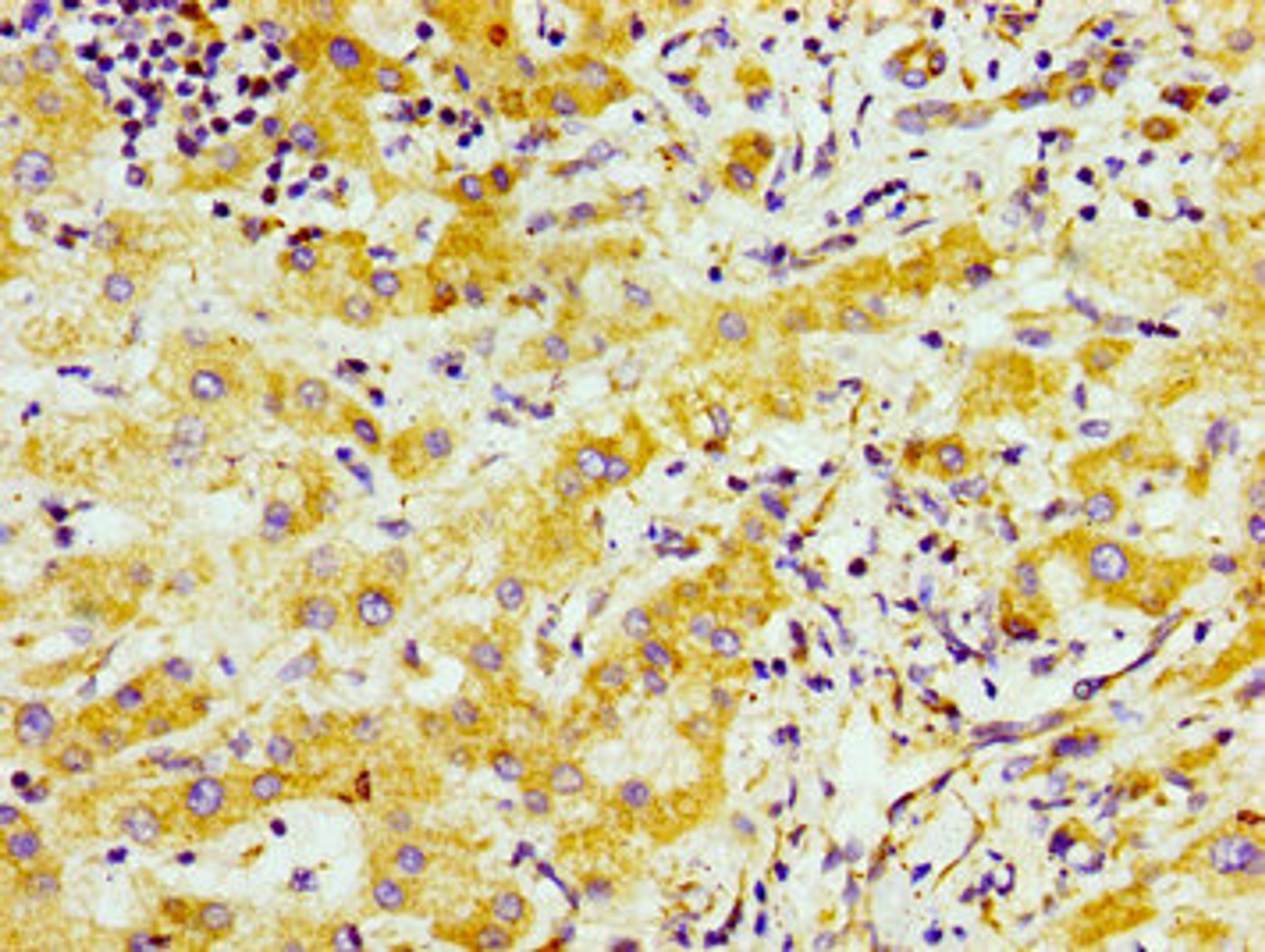 Immunohistochemistry of paraffin-embedded human liver cancer using CSB-PA745330LA01HU at dilution of 1:100