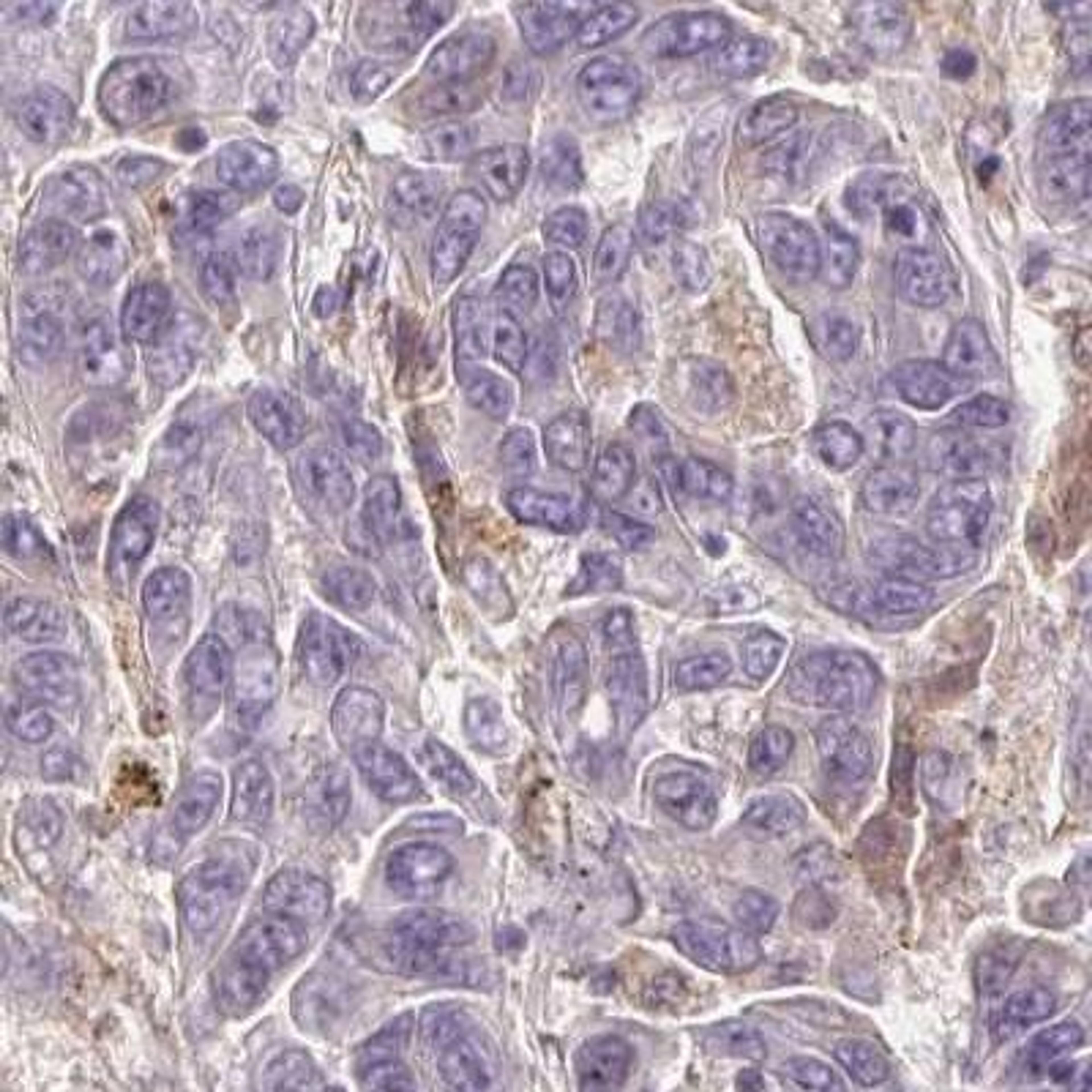 Immunohistochemistry: Cklfsf8 Antibody [NBP2-31594] - liver cancer