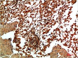 Immunohistochemical analysis of paraffin-embedded Human Lung Carcinoma Tissue using JNK2 Rabbit  pAb diluted at 1:200