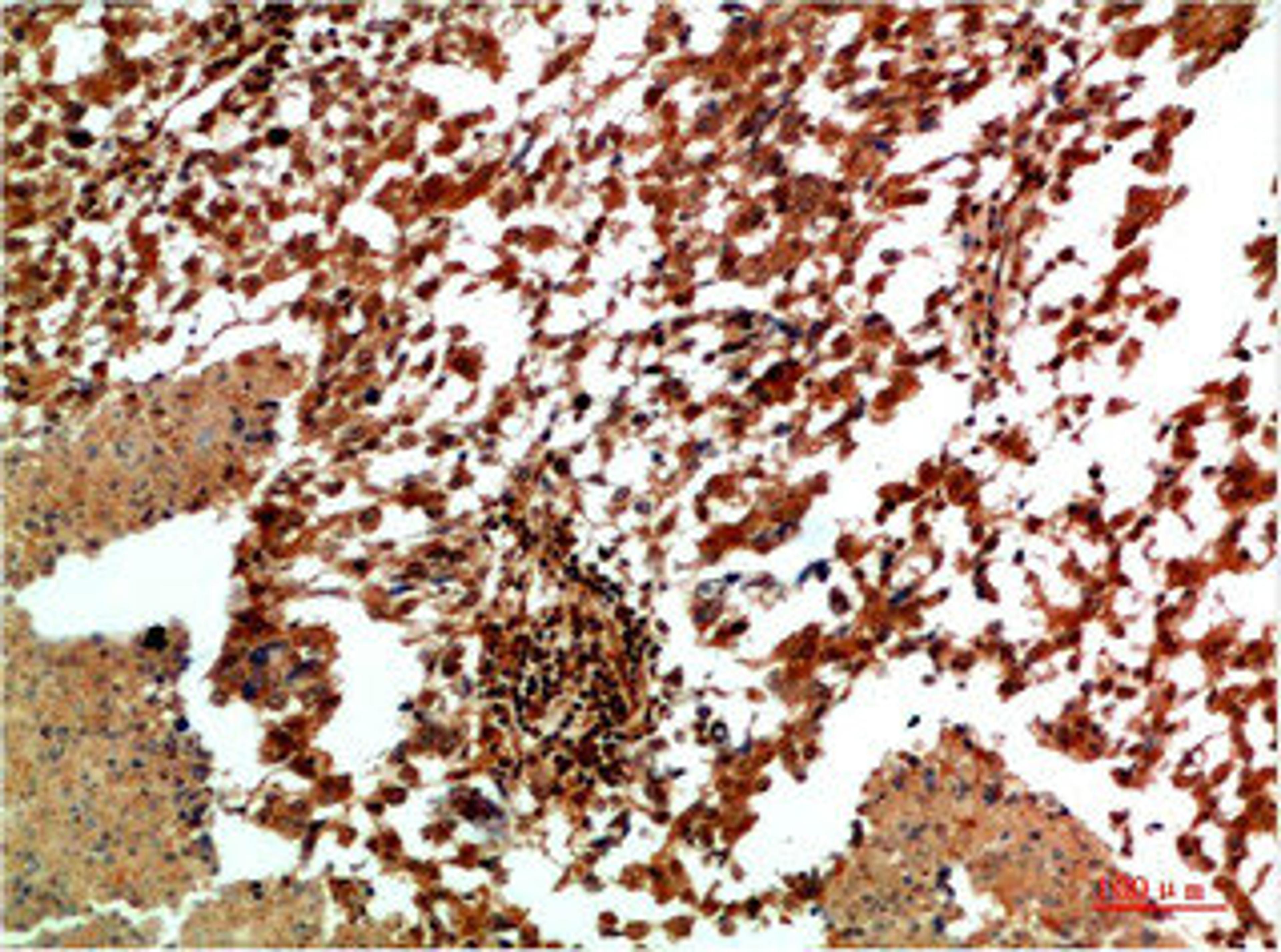 Immunohistochemical analysis of paraffin-embedded Human Lung Carcinoma Tissue using JNK2 Rabbit  pAb diluted at 1:200