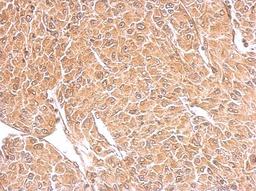 Immunohistochemistry-Paraffin: Tetraspanin-3 Antibody [NBP2-20604] - TSPAN3 antibody detects TSPAN3 protein at cytosol on U87 xenograft by immunohistochemical analysis. Sample: Paraffin-embedded U87 xenograft. TSPAN3 antibody dilution: 1:500.