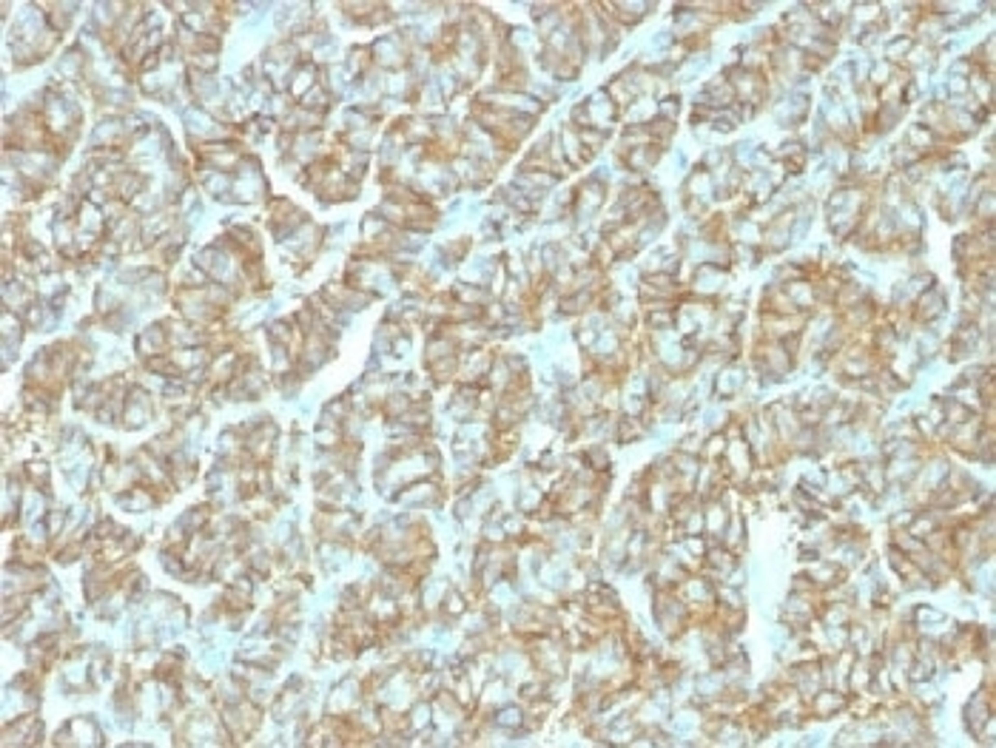 IHC testing of FFPE human thyroid carcinoma and recombinant EpCAM antibody (clone EGP40/1555R). Required HIER: steam sections in pH6 citrate buffer for 10-20 min.