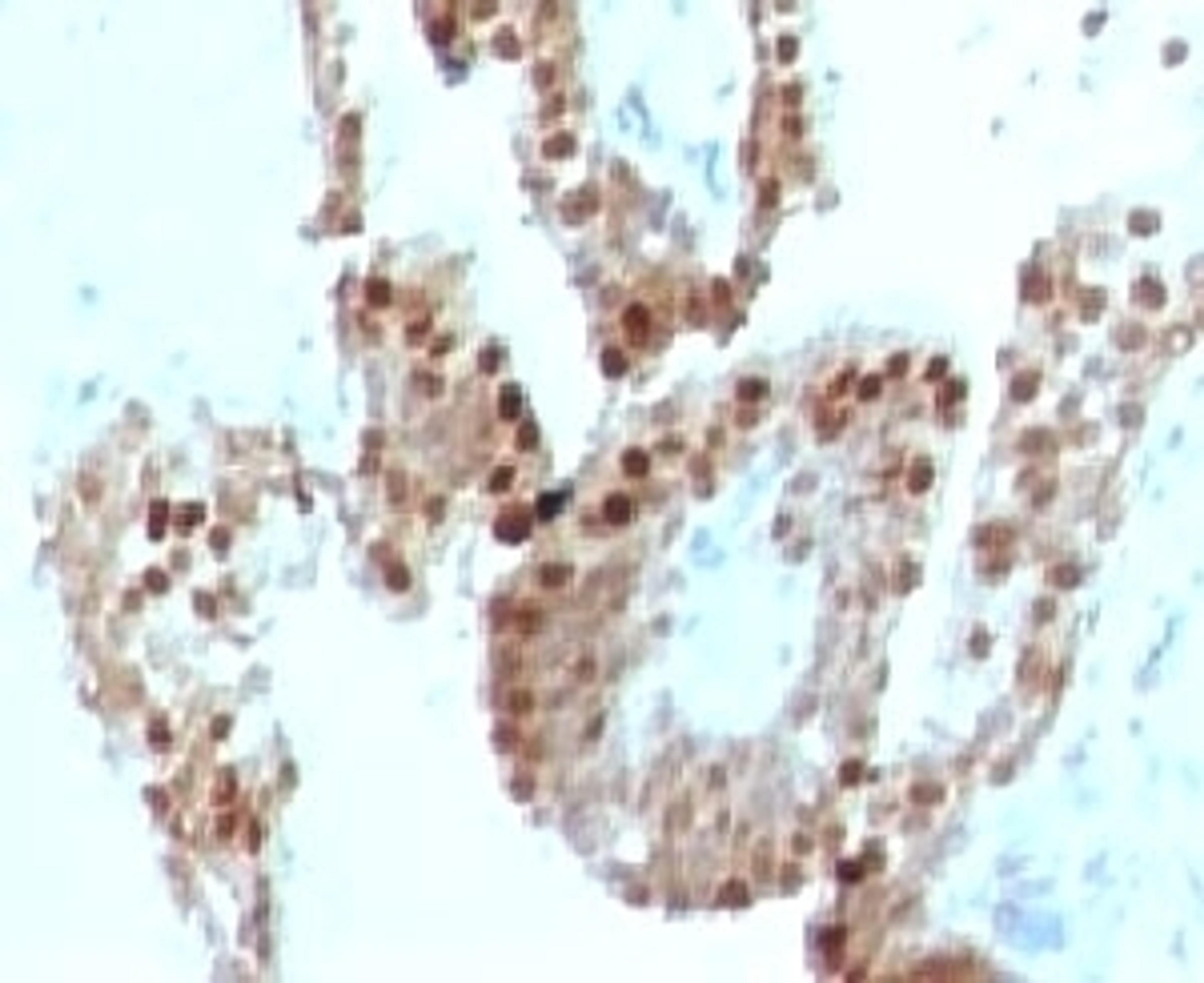 IHC testing of human prostate carcinoma and p57 antibody (clone KIP57-1)