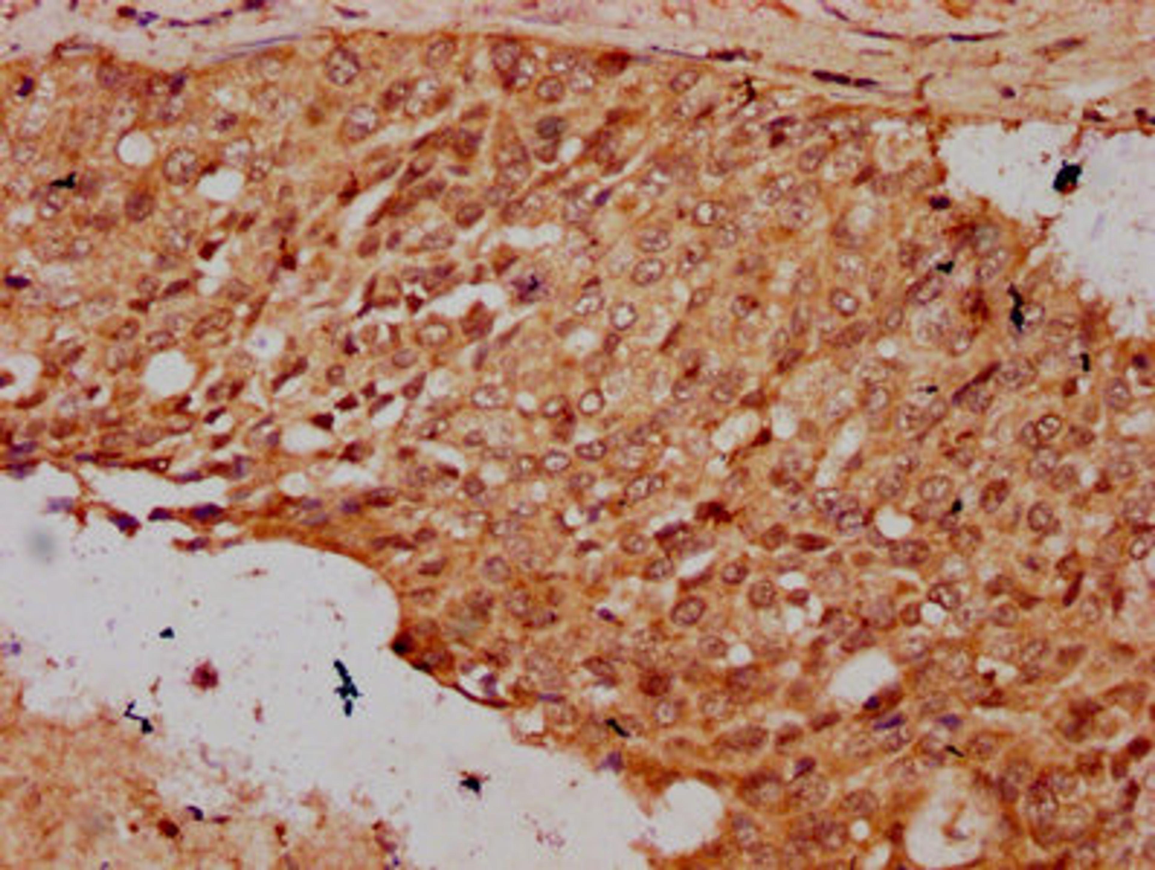 IHC image of CSB-PA010418OA23nsucHU diluted at 1:20 and staining in paraffin-embedded human cervical cancer performed on a Leica BondTM system. After dewaxing and hydration, antigen retrieval was mediated by high pressure in a citrate buffer (pH 6.0). Section was blocked with 10% normal goat serum 30min at RT. Then primary antibody (1% BSA) was incubated at 4°C overnight. The primary is detected by a biotinylated secondary antibody and visualized using an HRP conjugated SP system.