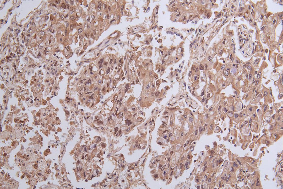 Immunohistochemistry of paraffin-embedded human ovarian cancer using CSB-PA026288LA01HU at dilution of 1:100