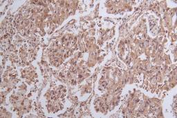 Immunohistochemistry of paraffin-embedded human ovarian cancer using CSB-PA026288LA01HU at dilution of 1:100