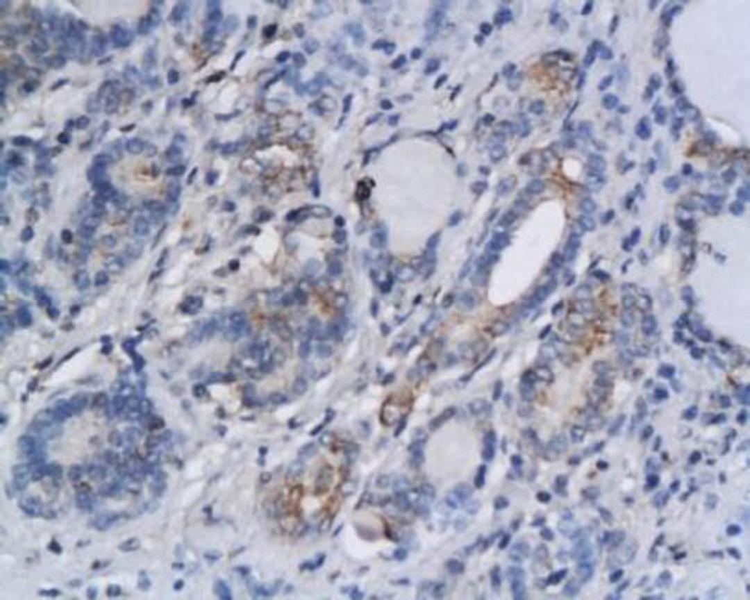 Immunohistochemical analysis of paraffin-embedded human thyroid cancer tissue using AHR antibody