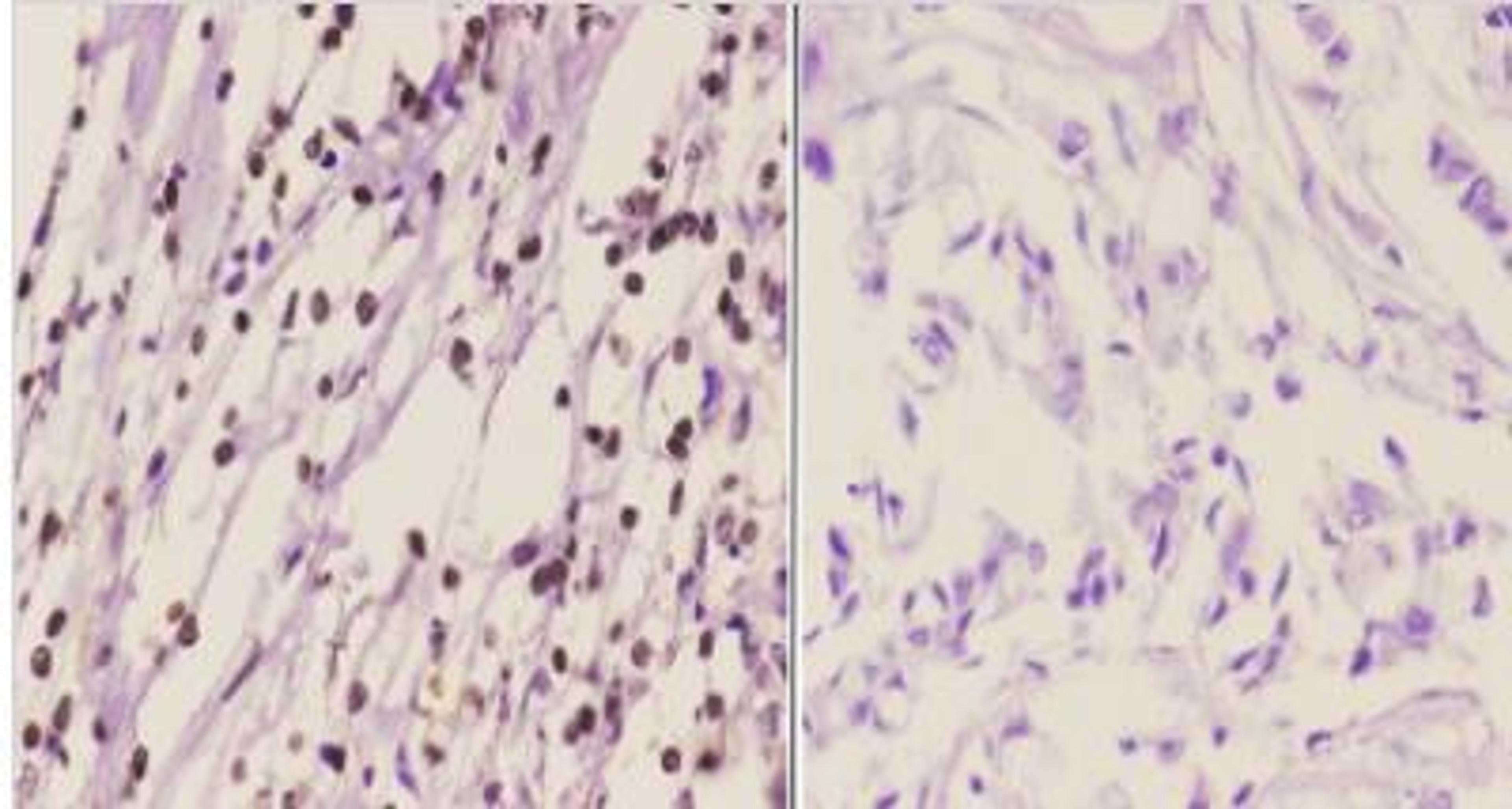 Immunohistochemistry-Paraffin: Chk1 [p Ser317] Antibody [NB100-92499] -  Paraffin-embedded human breast carcinoma tissue at 1:50.showing nuclear staining.  Negative control (the right)Using PBS instead of primary antibody, secondary antibody is Goat Anti-Rabbit IgG-bi