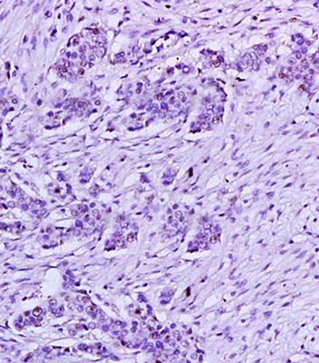 Immunohistochemical analysis of formalin fixed and paraffin embedded human tumor tissue using HPV16-E6/E6 antibody