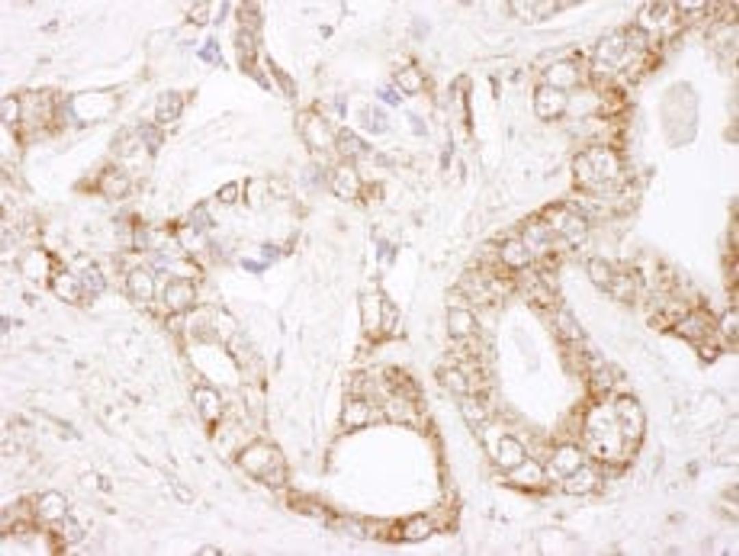 Detection of human Bcl-2 by immunohistochemistry.