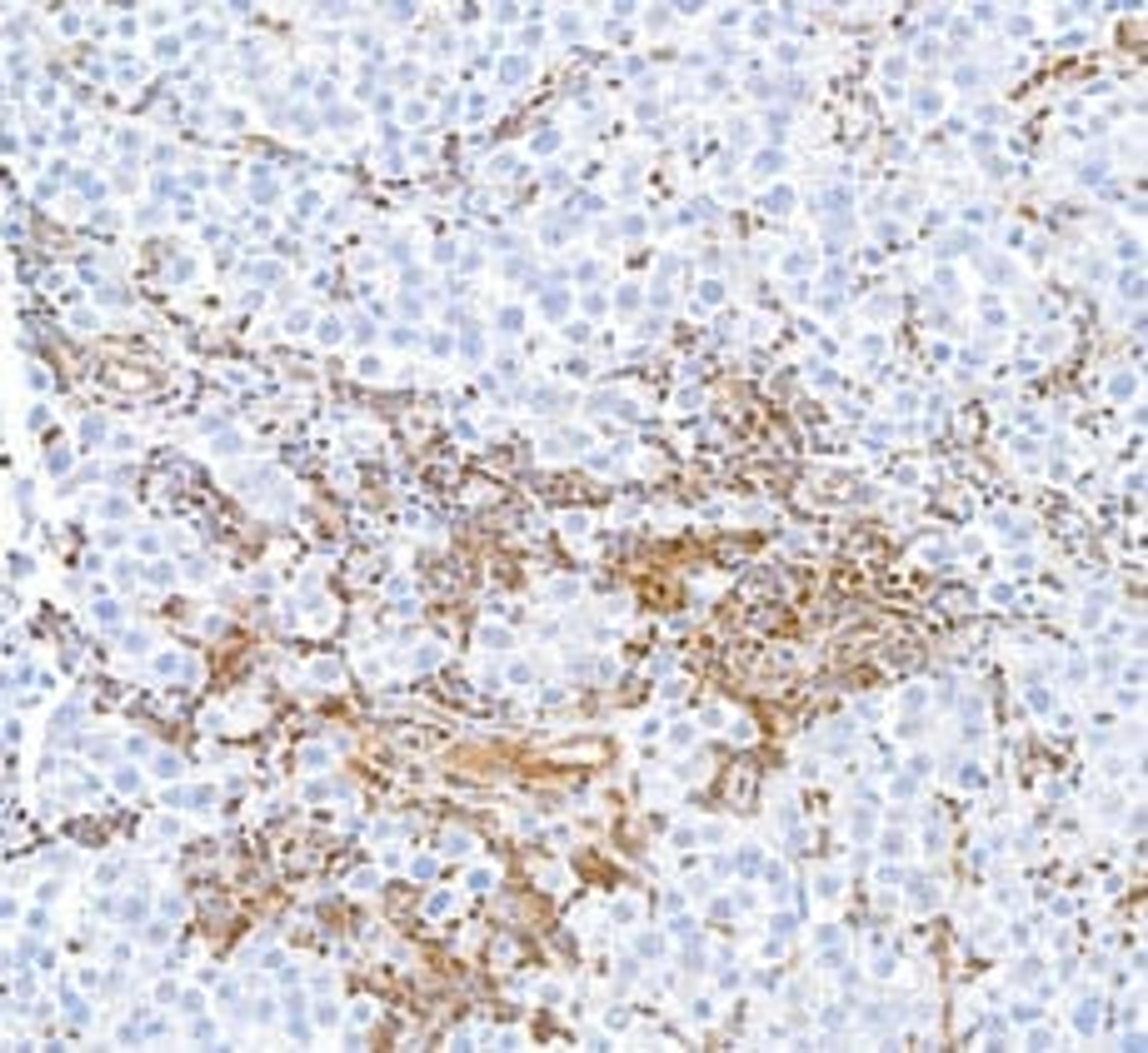 Detection of human STAT5a in FFPE testicular seminoma by  immunohistochemistry.