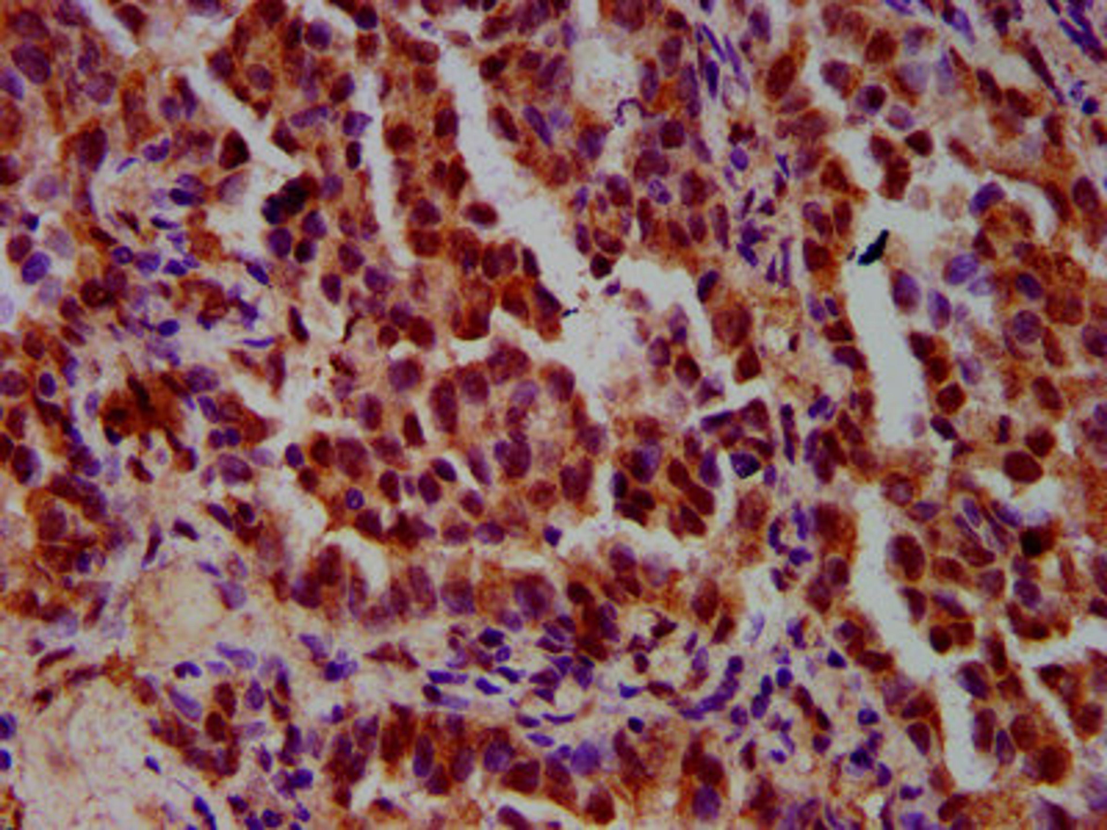 IHC image of CSB-PA22459A0Rb diluted at 1:600 and staining in paraffin-embedded human lung cancer performed on a Leica BondTM system. After dewaxing and hydration, antigen retrieval was mediated by high pressure in a citrate buffer (pH 6.0). Section was blocked with 10% normal goat serum 30min at RT. Then primary antibody (1% BSA) was incubated at 4°C overnight. The primary is detected by a biotinylated secondary antibody and visualized using an HRP conjugated SP system.