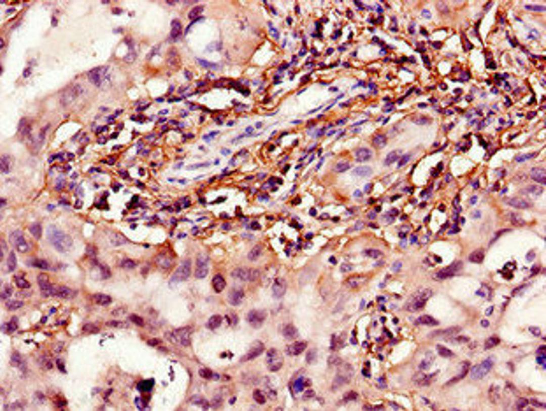 Immunohistochemistry of paraffin-embedded human lung cancer using CSB-PA010702LA01HU at dilution of 1:100