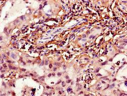 Immunohistochemistry of paraffin-embedded human lung cancer using CSB-PA010702LA01HU at dilution of 1:100