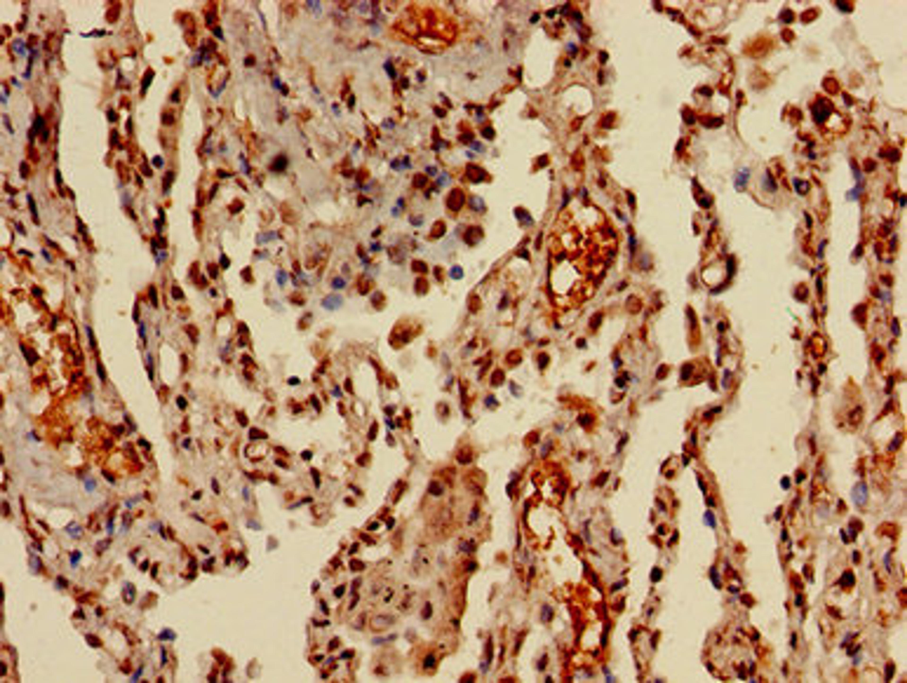 Immunohistochemistry of paraffin-embedded human lung cancer using CSB-PA010418PA36nme2HU at dilution of 1:100