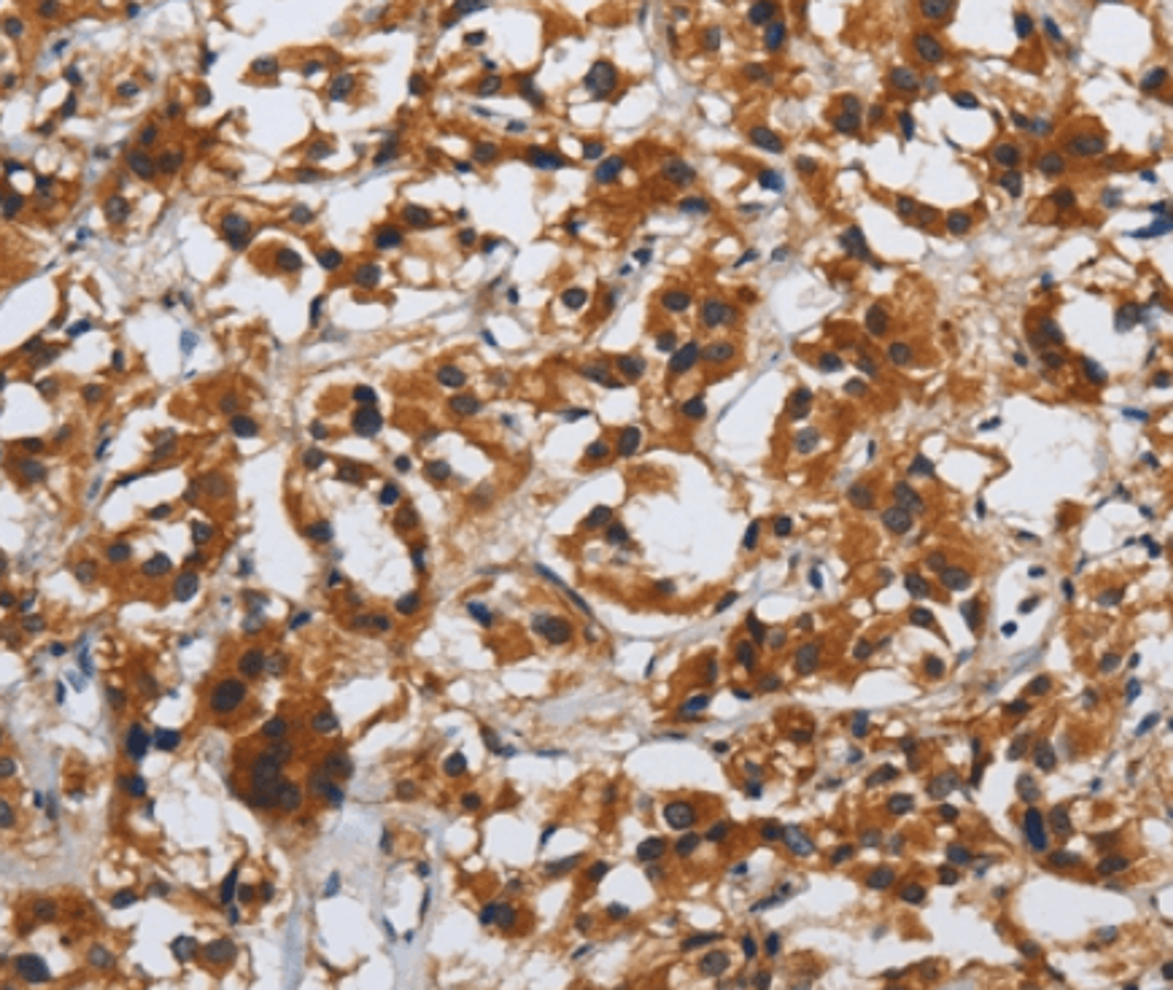 Immunohistochemical staining of Human thyroid cancer tissue using DSP antibody