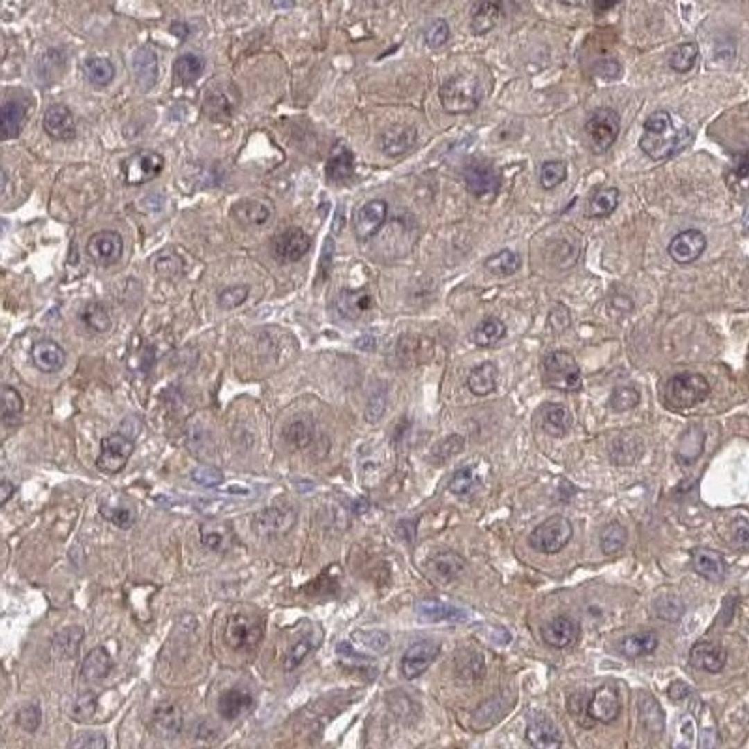 Immunohistochemistry: SLC9A6 Antibody [NBP2-32463] - liver cancer