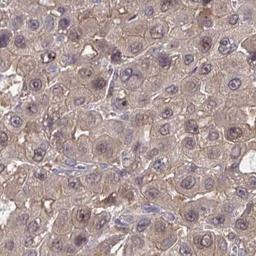 Immunohistochemistry: SLC9A6 Antibody [NBP2-32463] - liver cancer