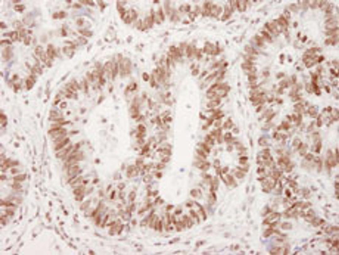 Detection of human Phospho-53BP1 (Ser 25) by immunohistochemistry.