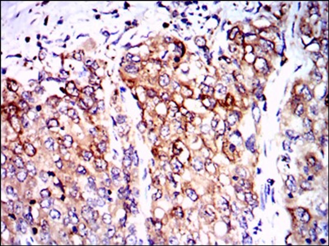 Immunohistochemistry: PP2A/PPP2R4 Antibody (4D9) [NBP2-37530] - Immunohistochemical analysis of paraffin-embedded lung cancer tissues using PPP2R4 mouse mAb with DAB staining.