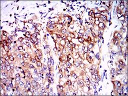 Immunohistochemistry: PP2A/PPP2R4 Antibody (4D9) [NBP2-37530] - Immunohistochemical analysis of paraffin-embedded lung cancer tissues using PPP2R4 mouse mAb with DAB staining.