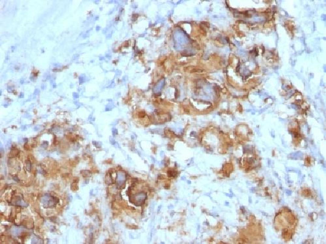 Immunohistochemical staining of human Gastric Carcinoma tissue using CA19-9 antibody