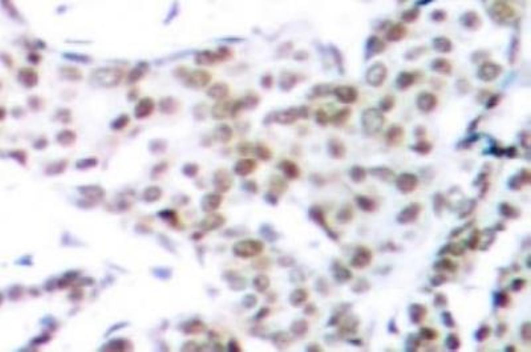 Immunohistochemistry-Paraffin: Tau [p Thr205] Antibody [NB100-92655] - Paraffin-embedded human breast  carcinoma tissue.