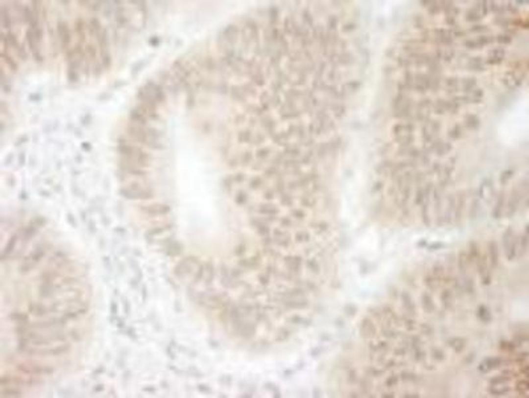 Immunohistochemistry-Paraffin: CDT2 Antibody [NB100-40840] - FFPE section of human colon carcinoma. Antibody: Affinity purified rabbit anti-DTL/CDT2 used at a dilution of 1:250. Detection: DAB staining using Immunohistochemistry Accessory Kit. Epitope Retrieval Buffer-High pH was substituted for Epitope Retrieval Buffer-Reduced pH.