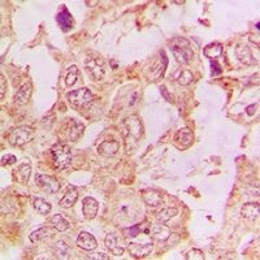 Immunohistochemical staining of human lung cancer tissue using DNM2 antibody