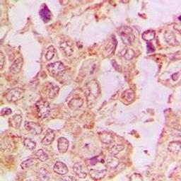 Immunohistochemical staining of human lung cancer tissue using DNM2 antibody