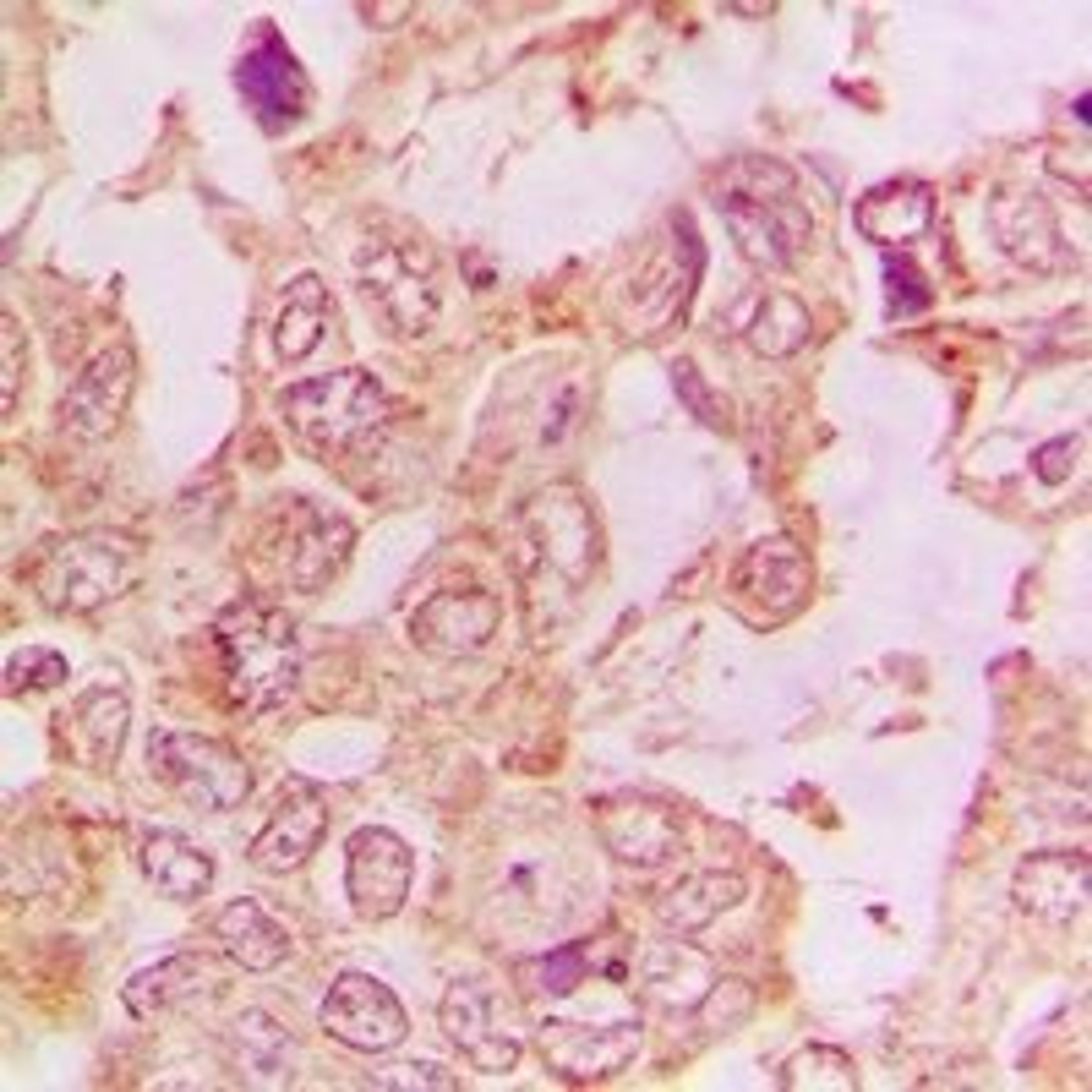 Immunohistochemical staining of human lung cancer tissue using DNM2 antibody