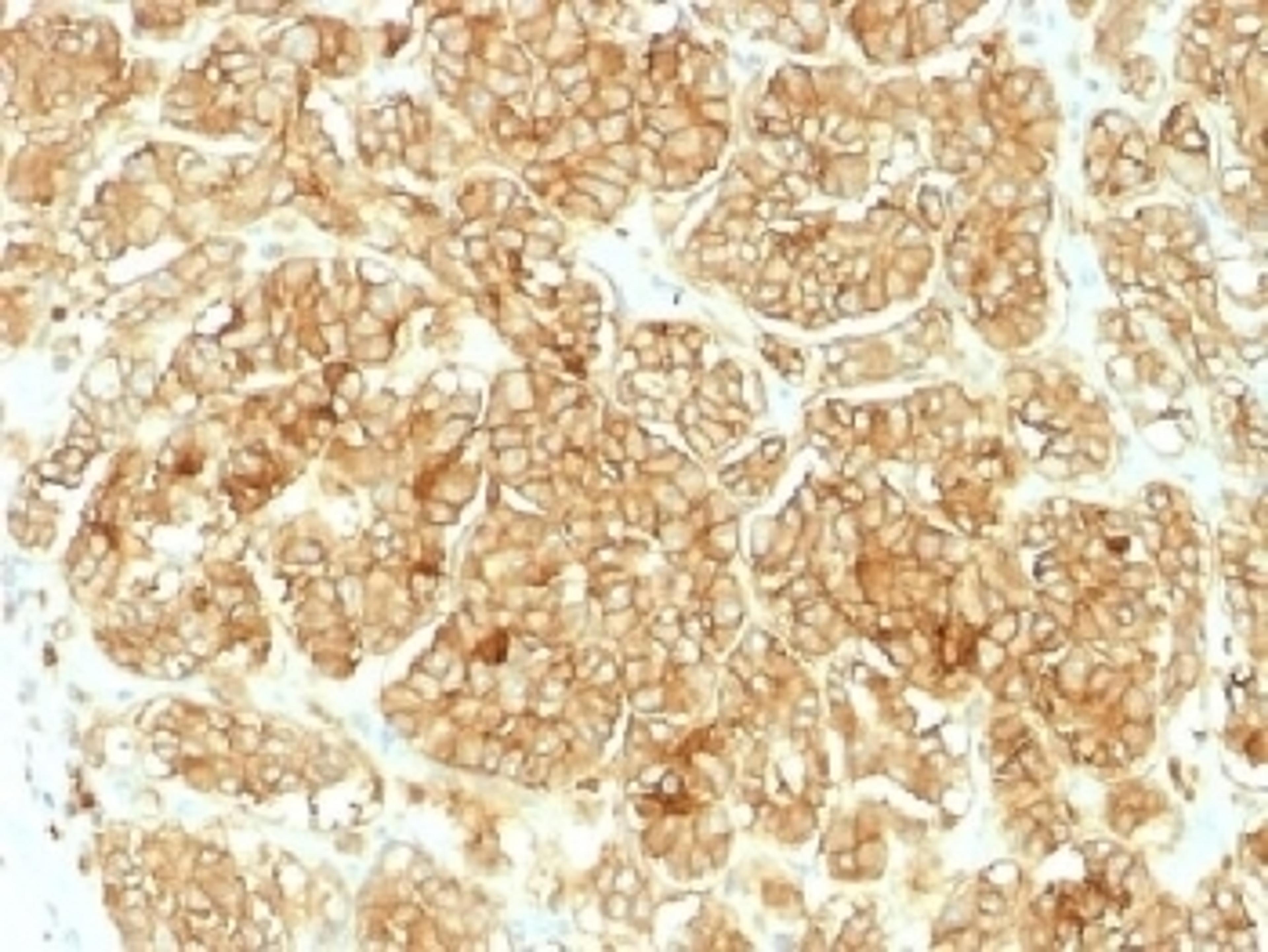 IHC testing of FFPE human renal cell carcinoma and EpCAM antibody. Required HIER: steam sections in pH6 citrate buffer for 10-20 min.