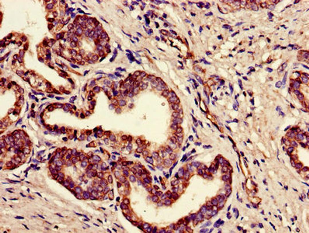 Immunohistochemistry of paraffin-embedded human prostate cancer using CSB-PA008227LA01HU at dilution of 1:100