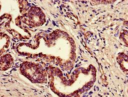 Immunohistochemistry of paraffin-embedded human prostate cancer using CSB-PA008227LA01HU at dilution of 1:100