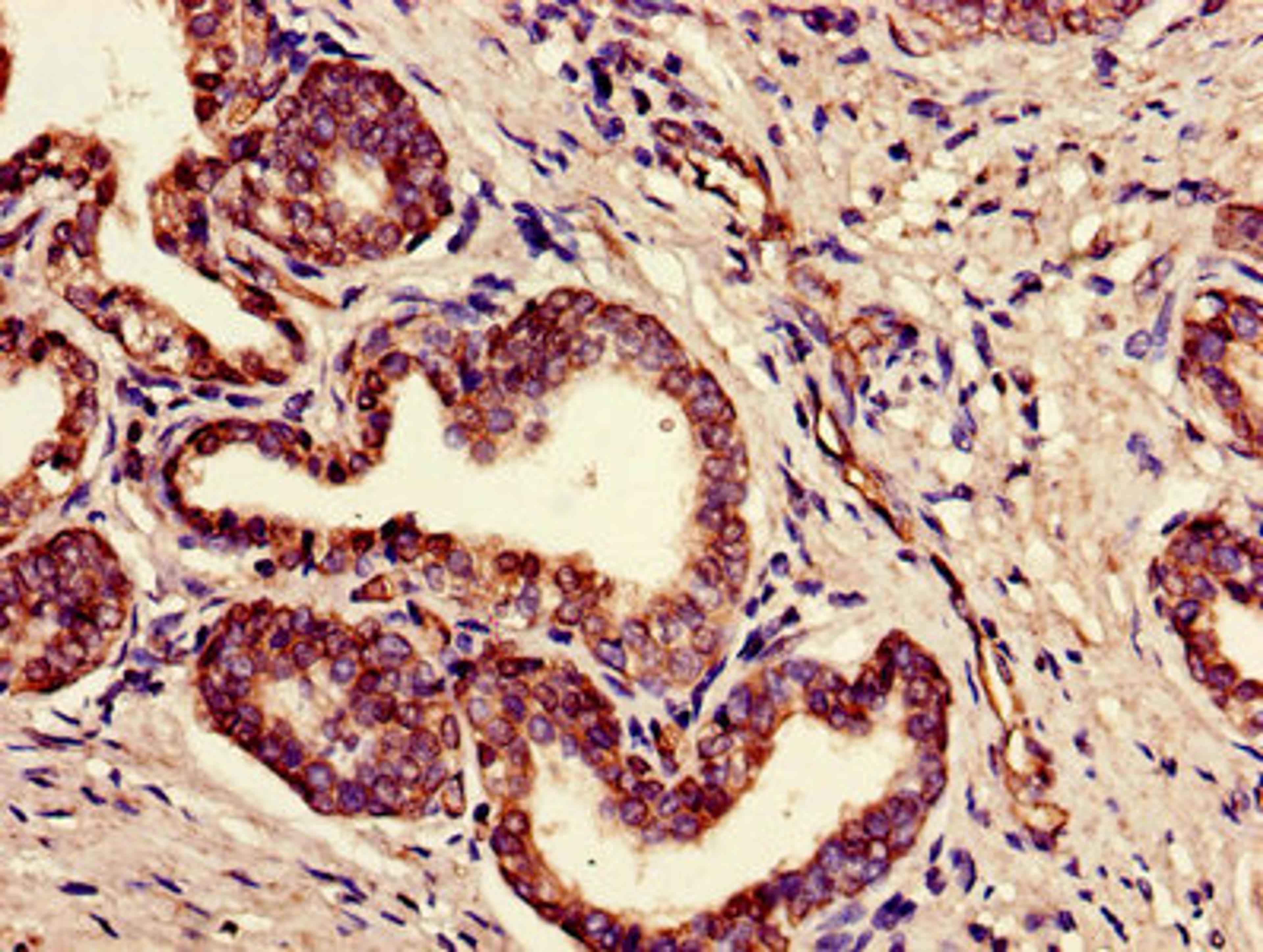 Immunohistochemistry of paraffin-embedded human prostate cancer using CSB-PA008227LA01HU at dilution of 1:100