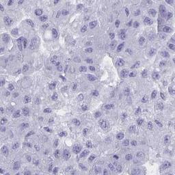 Immunohistochemistry: PRELP Antibody [NBP2-31861] - liver cancer