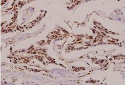 Immunohistochemistry-Paraffin: Carbonic Anhydrase II/CA2 Antibody [NBP1-19726] - Analyzes of Carbonic Anhydrase II/CA2) pAb in paraffin-embedded human breast carcinoma tissue at 1:100.