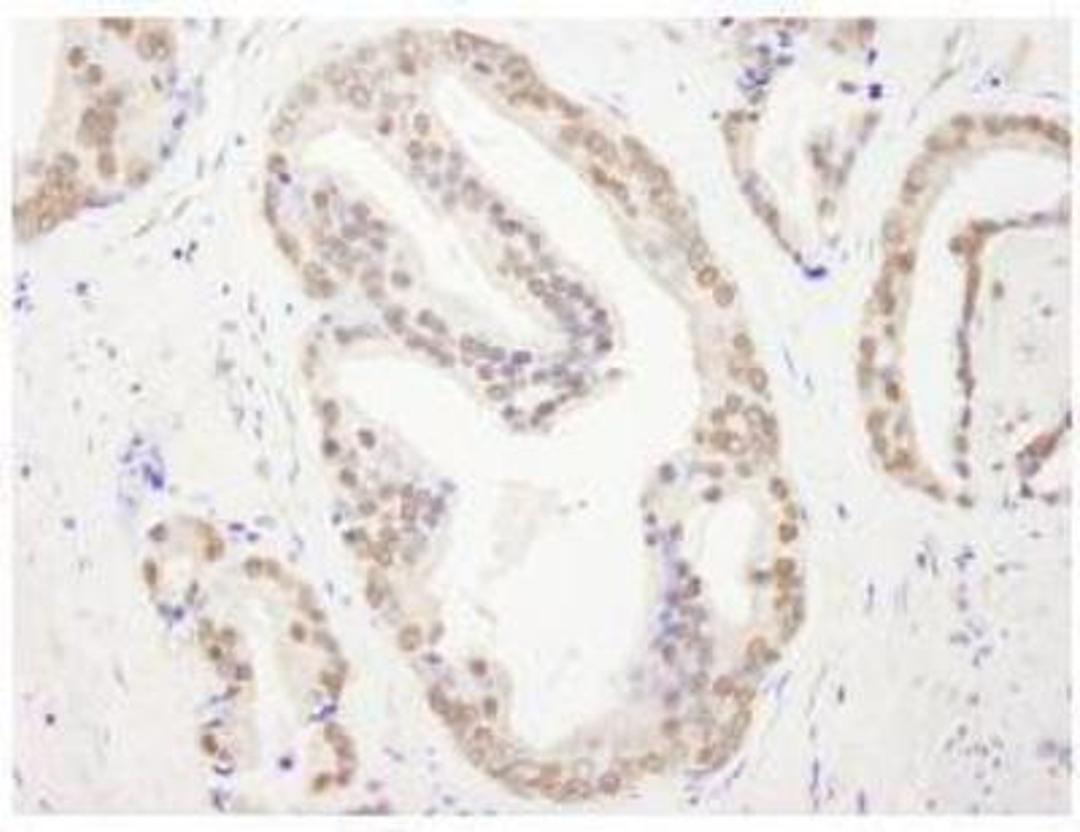 Immunohistochemistry-Paraffin: RBM26 Antibody [NB100-60408] - FFPE section of human prostate carcinoma.  Affinity purified rabbit anti-RBM26 used at a dilution of 1:250.