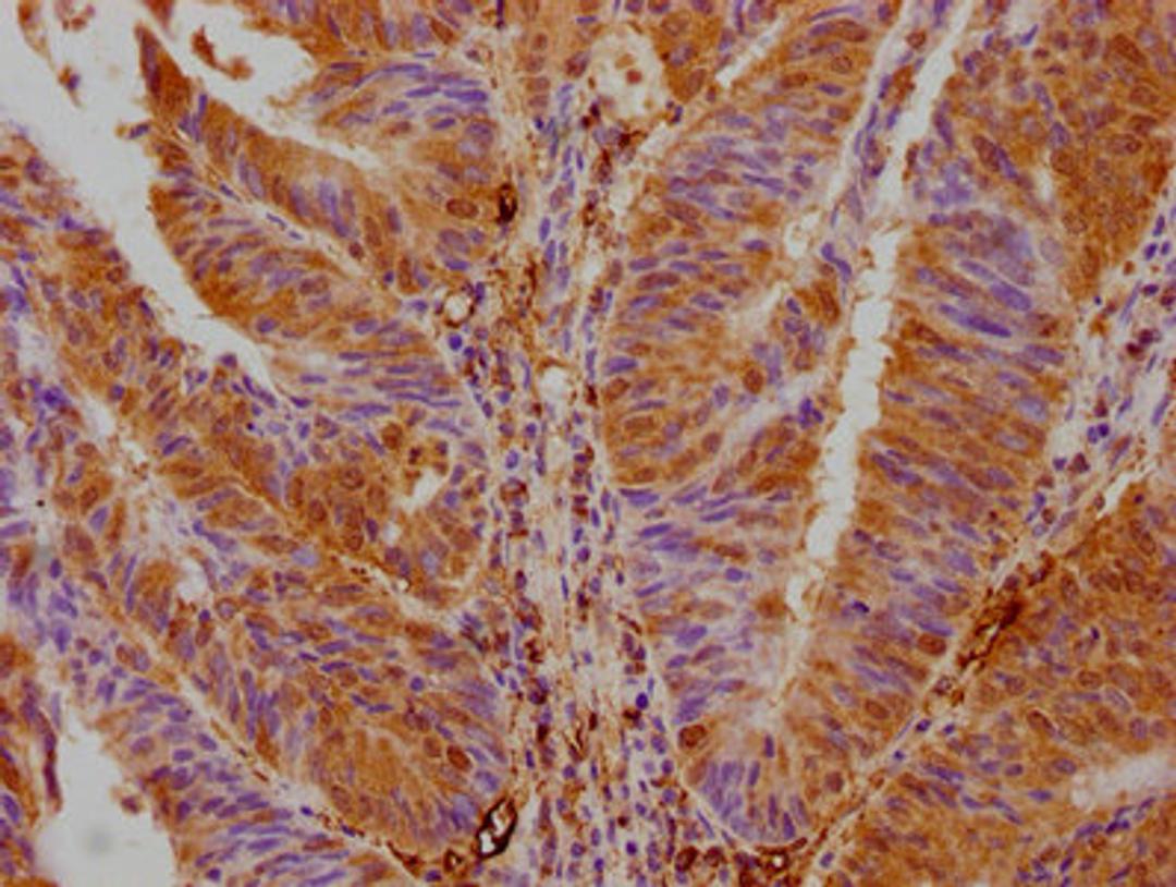 IHC image of CSB-PA862043LA01HU diluted at 1:700 and staining in paraffin-embedded human colon cancer performed on a Leica BondTM system. After dewaxing and hydration, antigen retrieval was mediated by high pressure in a citrate buffer (pH 6.0). Section was blocked with 10% normal goat serum 30min at RT. Then primary antibody (1% BSA) was incubated at 4&deg;C overnight. The primary is detected by a biotinylated secondary antibody and visualized using an HRP conjugated SP system.