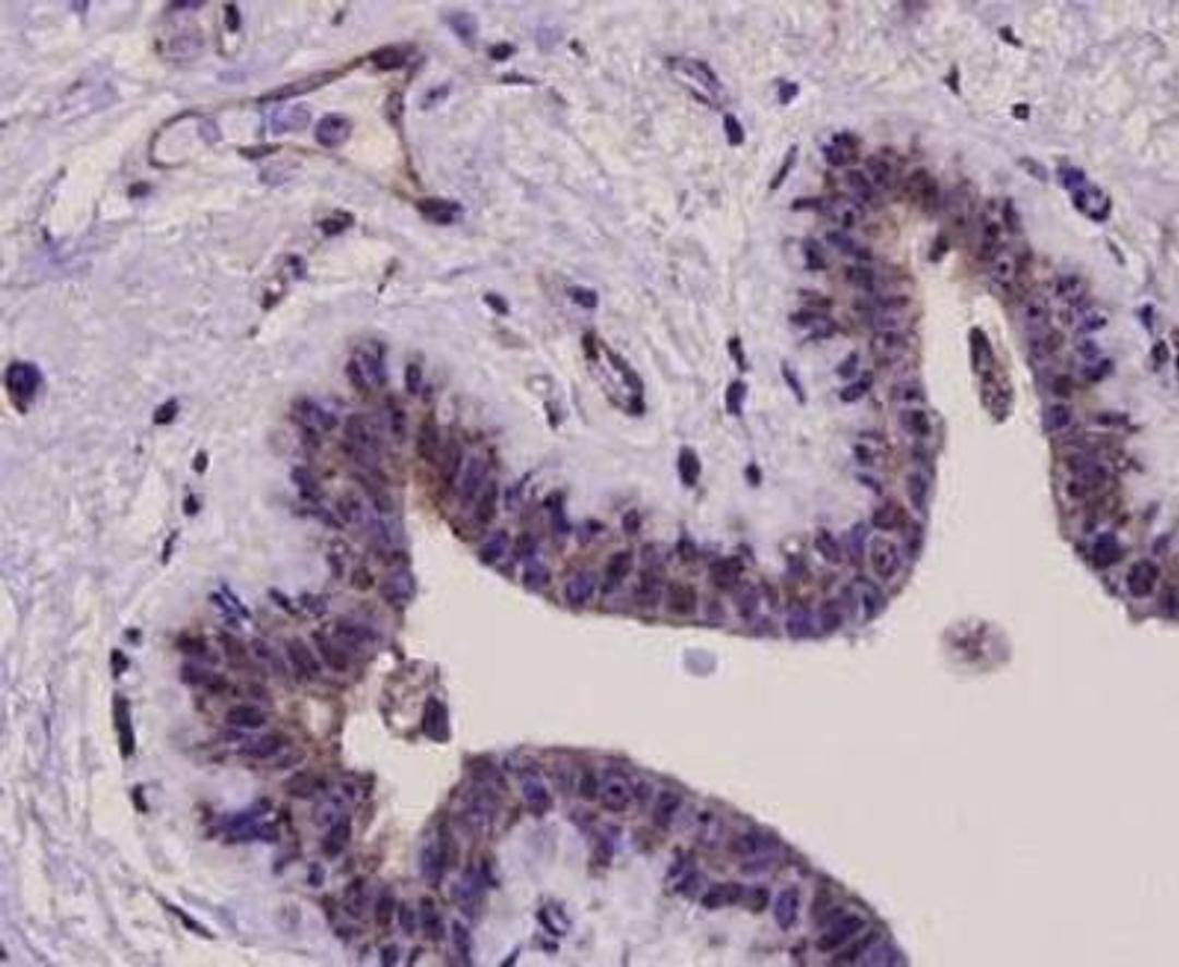 Immunoistochemical staining of human breast carcinoma tissue using ERK1 antibody