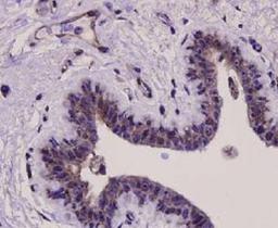 Immunoistochemical staining of human breast carcinoma tissue using ERK1 antibody