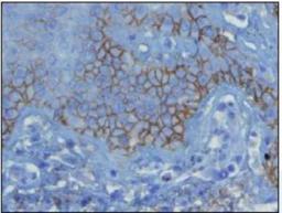 Immunohistochemistry-Paraffin: Complement C3d Antibody (E28-P) [NBP1-79074] - Formalin-fixed and paraffin-embedded human skin biopsy (4 um) from lesion of the early pemphigus vulgaris (without blister formation), stained with anti-C3d complement antibody shows strong positive intraepidermal intercellular immunostaining.