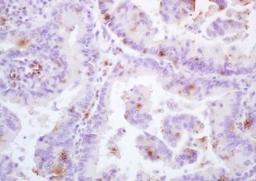 Immunohistochemical analysis of formalin-fixed paraffin embedded Human lung cancer tissue using HPV16 E6 protein antibody (dilution at 1:200)