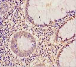 Immunohistochemistry of paraffin-embedded human colon cancer using CSB-PA007582LA01HU at dilution of 1:100