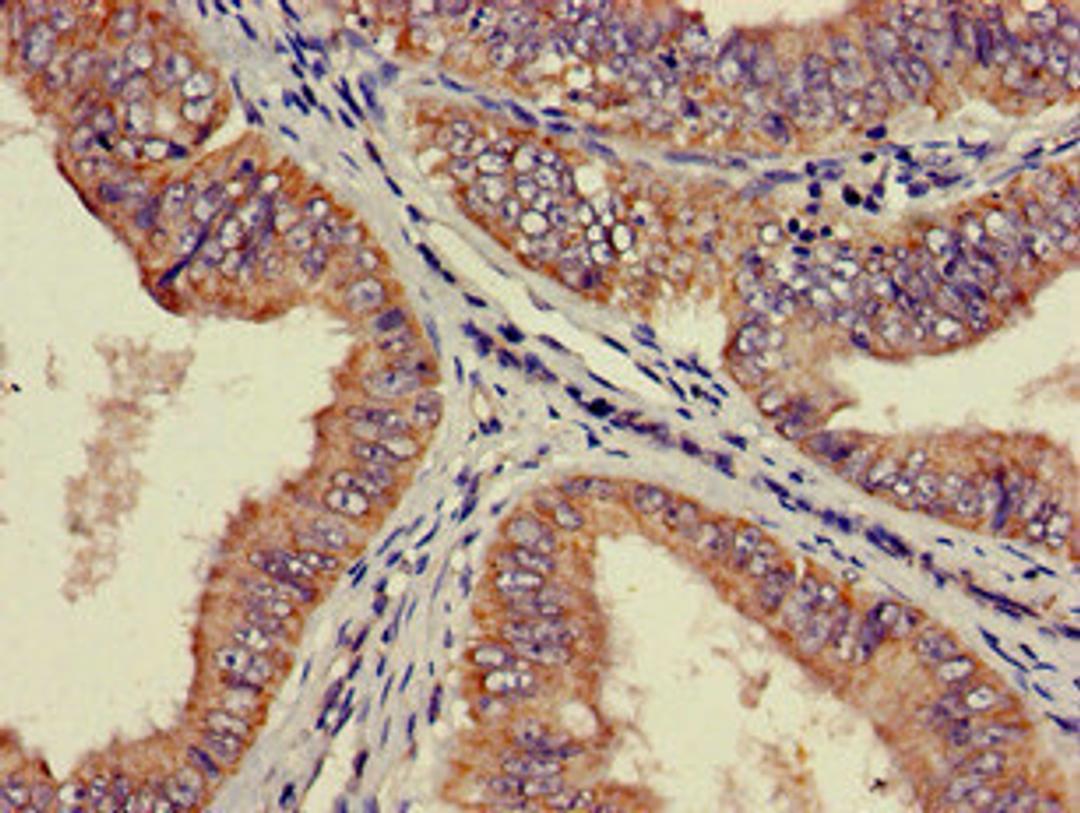 Immunohistochemistry of paraffin-embedded human endometrial cancer using CSB-PA020399LA01HU at dilution of 1:100