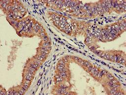 Immunohistochemistry of paraffin-embedded human endometrial cancer using CSB-PA020399LA01HU at dilution of 1:100