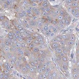 Immunohistochemistry: RAB11FIP5 Antibody [NBP2-32662] - liver cancer